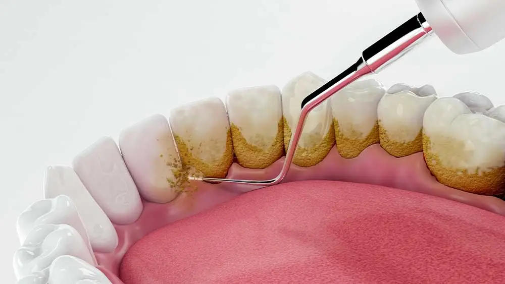 How to Remove Plaque from Teeth and Prevent Tartar Forming